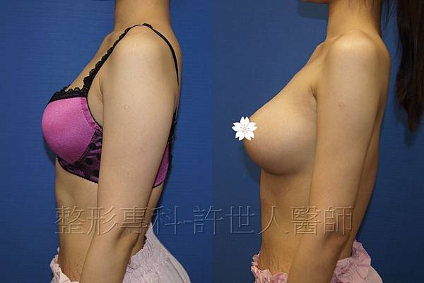 手臂環抽,手臂抽脂(蝴蝶袖) 4 內視鏡水蜜桃果凍矽膠隆乳-1