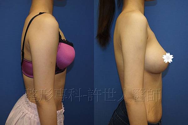 內視鏡水蜜桃果凍矽膠隆乳-2 內視鏡水蜜桃果凍矽膠隆乳 2