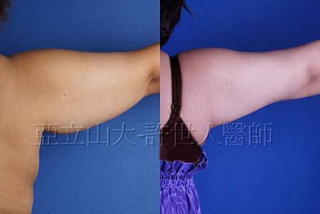 手臂環抽,手臂抽脂(蝴蝶袖) 15 嚴重的蝴蝶袖-抽脂手術-03