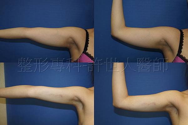 手臂環抽,手臂抽脂(蝴蝶袖) 1 手臂環抽,手臂抽脂-許世人醫師實際案例分享