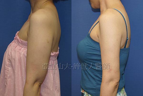 手臀抽脂-許世人醫師案例分享-1 手臀抽脂 許世人醫師案例分享 1