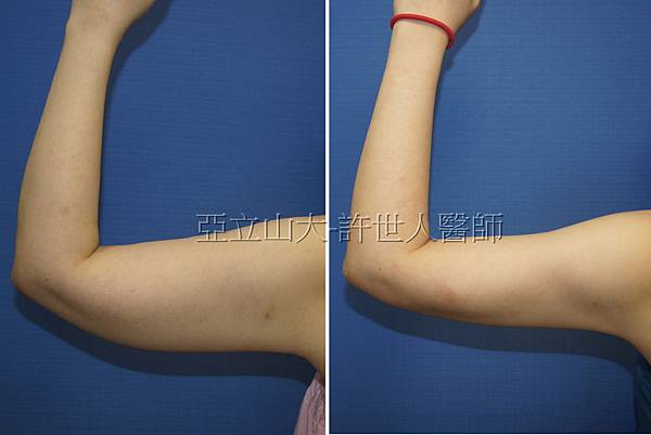 手臀抽脂-許世人醫師案例分享-2 手臂環抽,手臂抽脂-許世人醫師實際案例分享