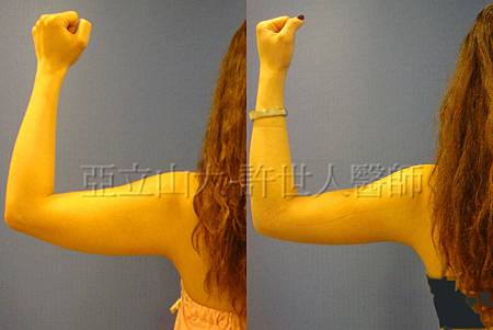 手臀抽脂(許世人醫師)-1 手臂環抽,手臂抽脂