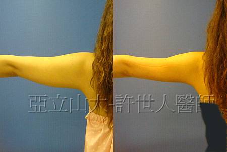 手臀抽脂(許世人醫師)-3 手臂環抽,手臂抽脂-許世人醫師案例1分享