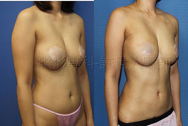 手臂環抽,手臂抽脂(蝴蝶袖) 8 手臂抽脂和腰腹環抽+ 背部超音波抽脂-2