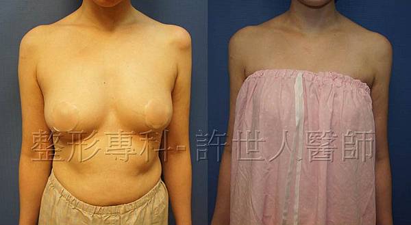 手臂環抽,手臂抽脂(蝴蝶袖) 10 手臂抽脂案例(許世人醫師)