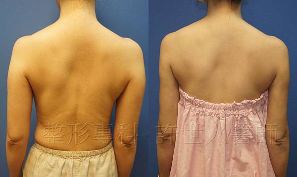 手臂環抽,手臂抽脂(蝴蝶袖) 12 手臂抽脂案例(許世人醫師)