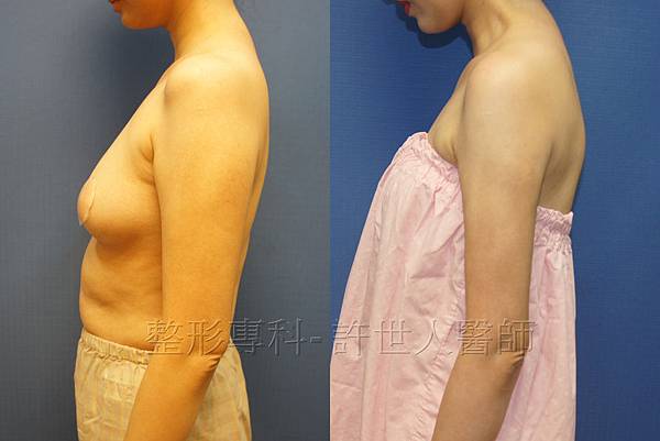 手臂環抽,手臂抽脂(蝴蝶袖) 11 手臂抽脂案例(許世人醫師)