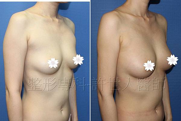 手臂環抽,手臂抽脂(蝴蝶袖) 21 手臂環抽+後大腿抽脂+自體脂肪隆乳脂肪隆乳-2