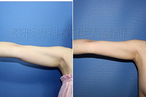 手臂環抽,手臂抽脂(蝴蝶袖) 22 手臂抽脂案例 (許世人醫師)