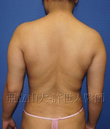 手臂環抽,手臂抽脂(蝴蝶袖) 24 手臂抽脂案例 (許世人醫師)