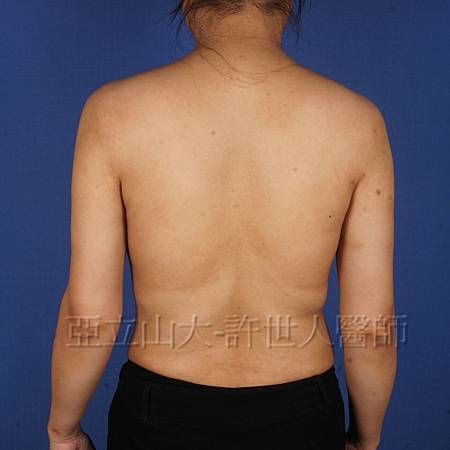 手臂環抽,手臂抽脂(蝴蝶袖) 26 手臂抽脂案例 (許世人醫師)