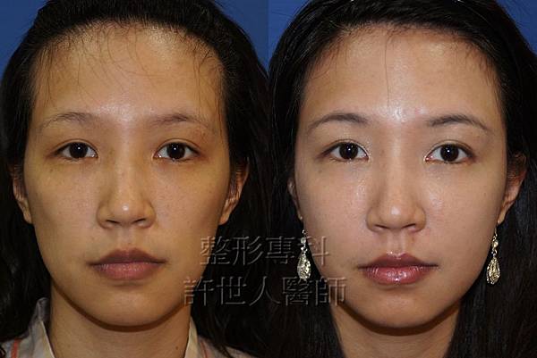 全臉補脂(自體脂肪補臉) 2 案例-自體脂肪全臉雕塑術後4個月-2