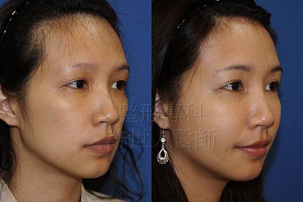全臉補脂(自體脂肪補臉) 4 案例-自體脂肪全臉雕塑術後4個月-5