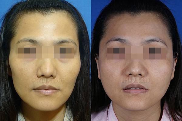 自體脂肪雕塑太陽穴、淚溝、臉頰） 1