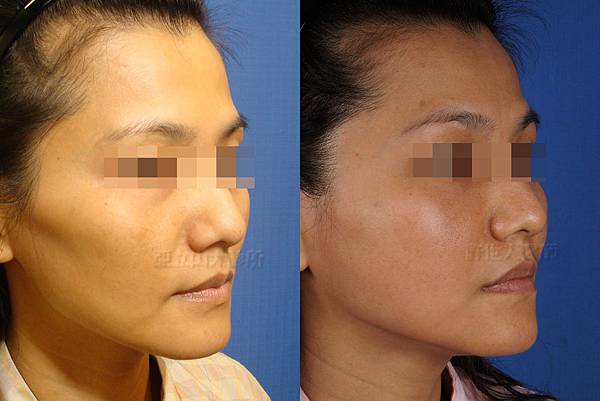自體脂肪雕塑太陽穴、淚溝、臉頰） 2