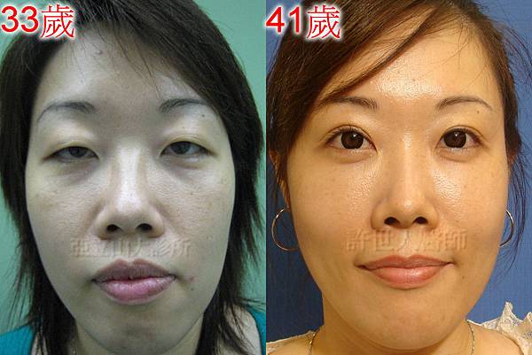 自體脂肪雕塑案例分享 1