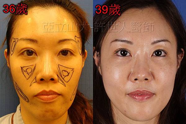 自體脂肪雕塑案例分享-2 自體脂肪補臉,全臉補脂 -許世人醫師案例分享