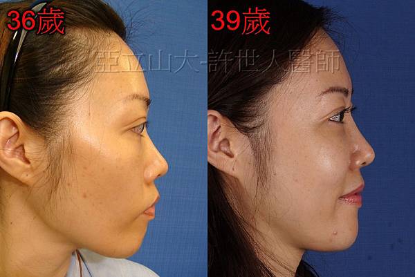 自體脂肪雕塑案例分享 5