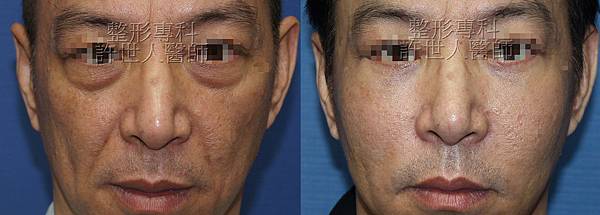 自體脂肪雕塑蘋果肌、前臉頰）法令紋刀第五代五合一眼袋脂肪 移位手術 2