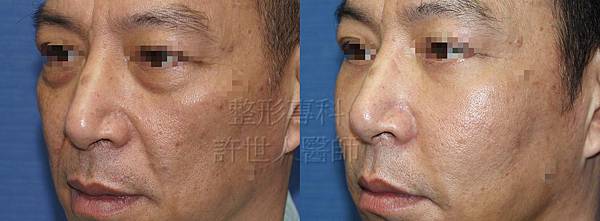 自體脂肪雕塑(蘋果肌、前臉頰）+法令紋刀+第五代五合一眼袋脂肪 移位手術 -3