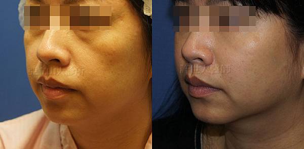 蘋果肌補脂-自體脂肪雕塑(蘋果肌、淚溝、前臉頰）