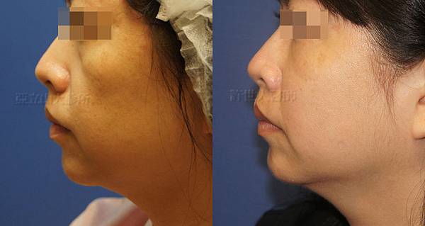 自體脂肪雕塑蘋果肌、淚溝、前臉頰） 3