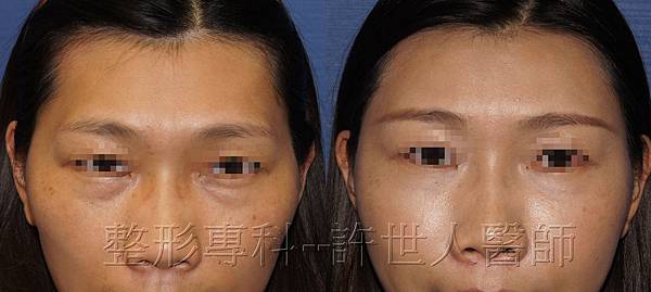 全臉補脂(自體脂肪補臉) 19 自體脂肪雕塑額頭、太陽穴、蘋果肌、淚溝、臉頰、山根-2.jpg