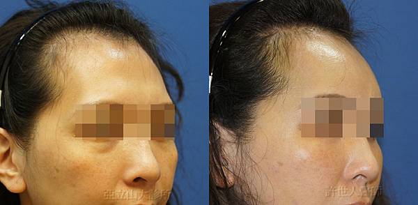 自體脂肪雕塑額頭、太陽穴、蘋果肌、淚溝） 2