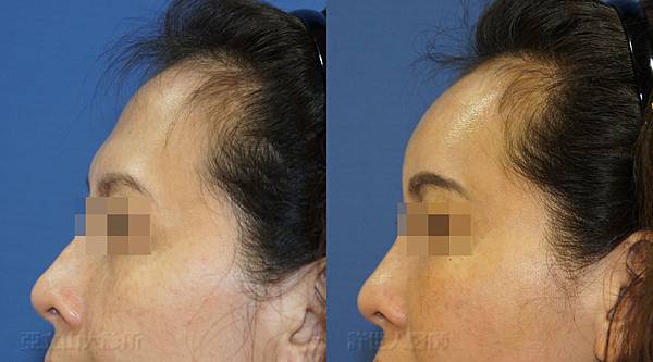 自體脂肪雕塑額頭、太陽穴、蘋果肌、淚溝） 3