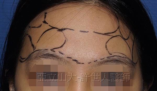 自體脂肪補臉雕塑:額頭、太陽穴(許世人醫師案例)