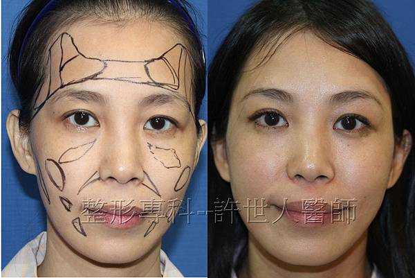體脂肪雕塑(額頭、太陽穴、蘋果肌、淚溝、臉頰）-1