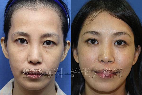 體脂肪雕塑額頭、太陽穴、蘋果肌、淚溝、臉頰） 2