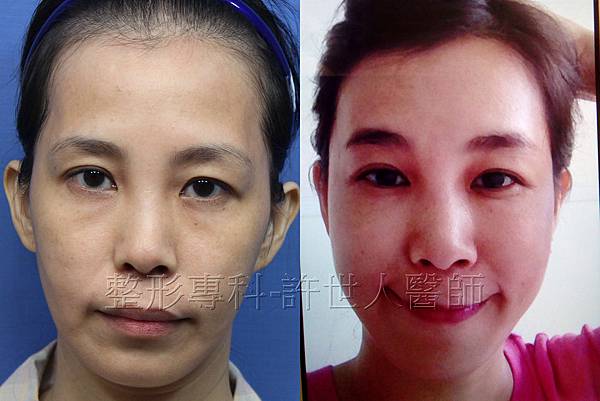 體脂肪雕塑(額頭、太陽穴、蘋果肌、淚溝、臉頰）-7