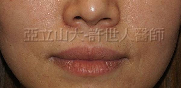 1 微笑嘴唇上唇 01