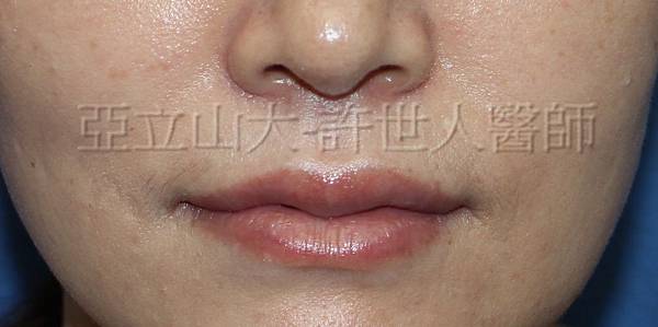 1 微笑嘴唇上唇 2