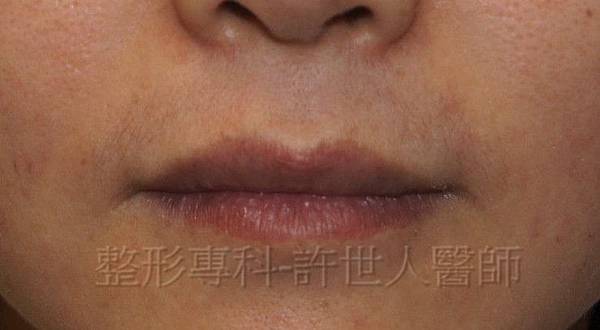 2 微笑嘴唇上唇 1