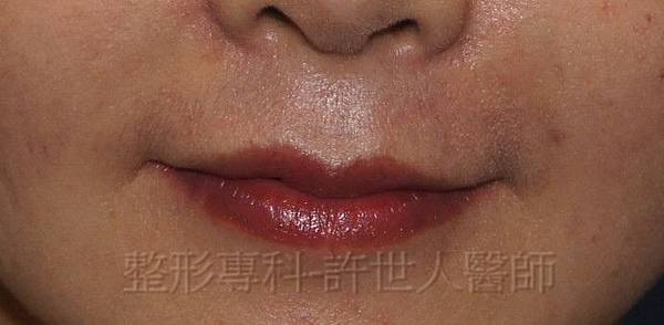 2 微笑嘴唇上唇 2