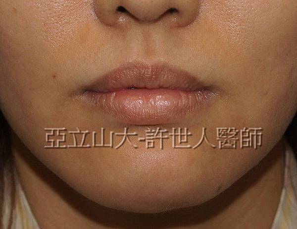 3 微笑嘴唇上唇 1