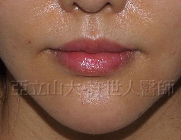 3 微笑嘴唇上唇 2