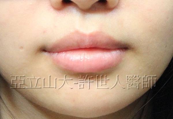 5 微笑嘴唇 1