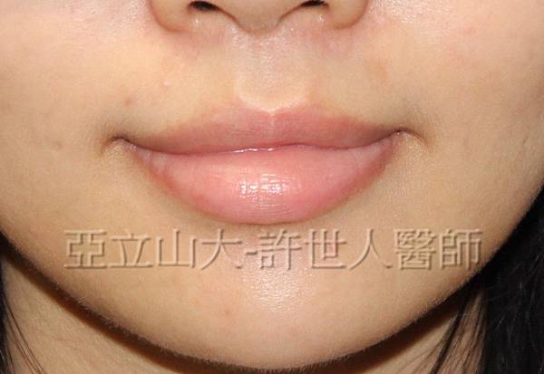 5 微笑嘴唇 3