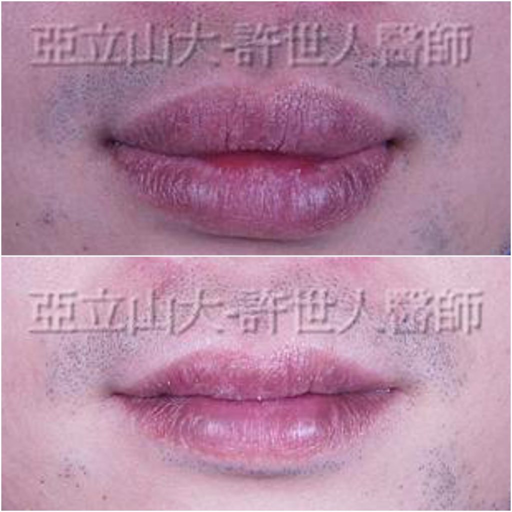 縮唇手術 案例分享