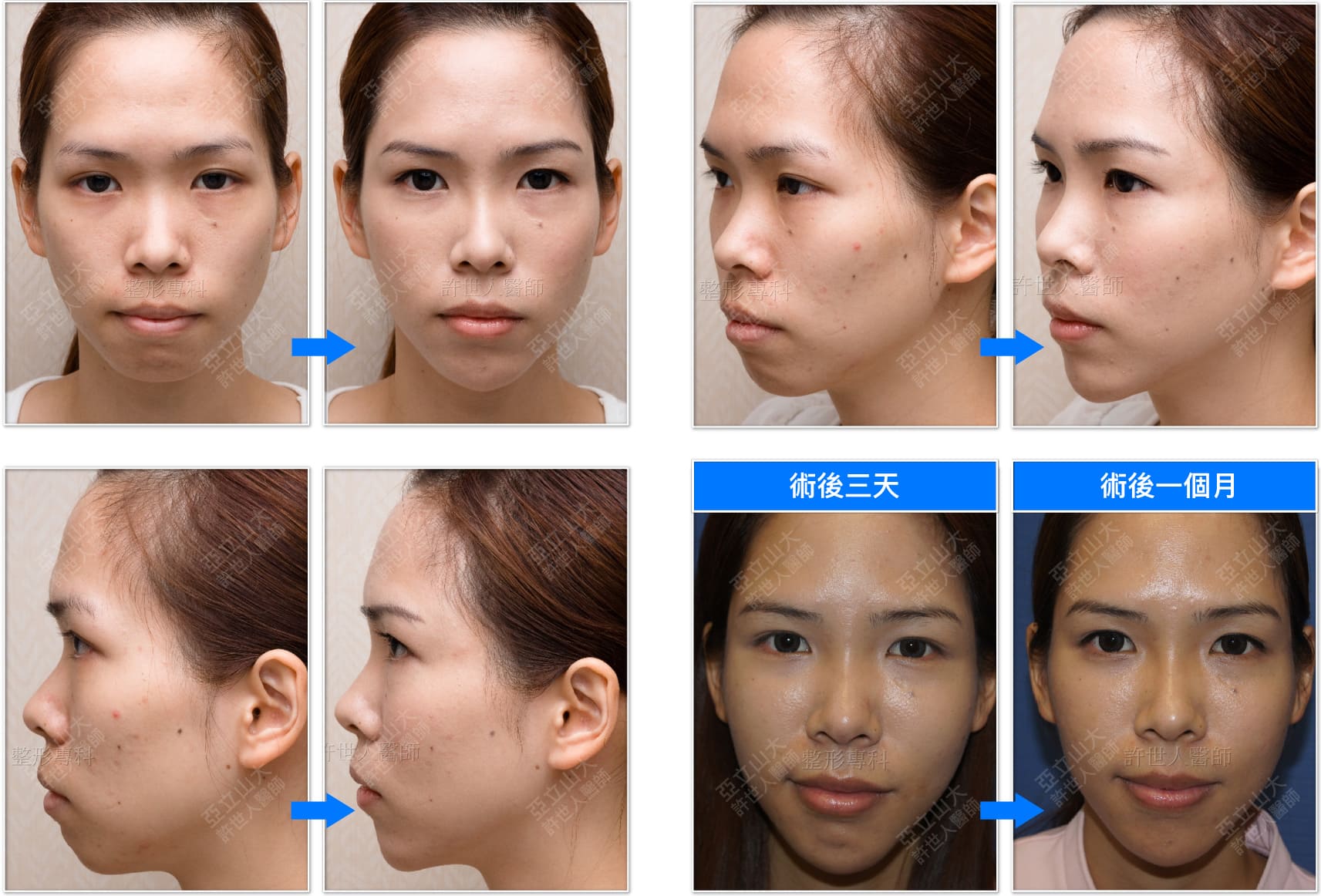 Hyaluronic acid injection 081