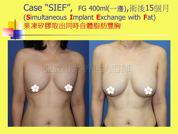 SIEF假體取出自體脂肪移植豐胸1
