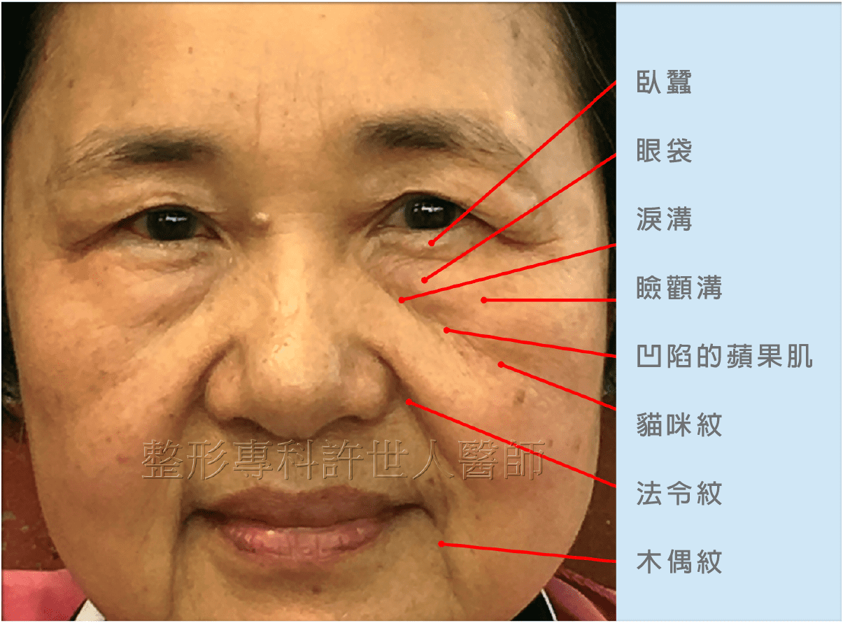 liuheyi eye bag fat 2