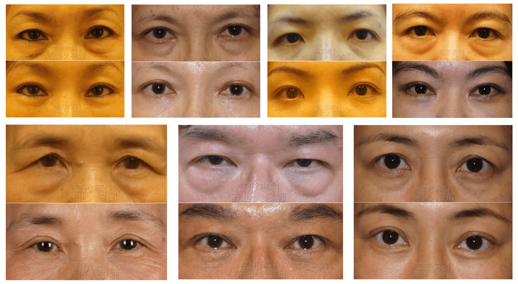 liuheyi eye bag fat 9