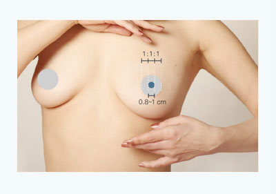 內視鏡矽膠假體隆乳 25 乳頭整形