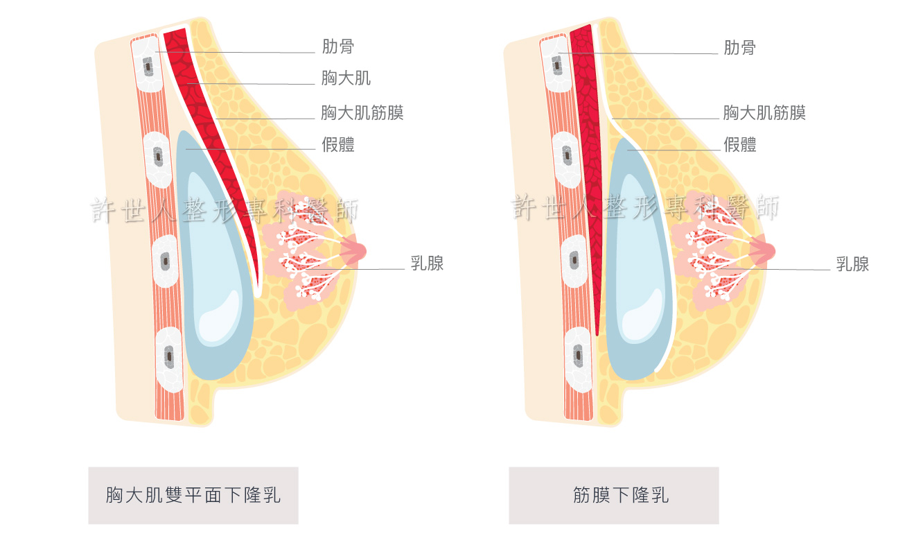 內視鏡隆乳-2021-1 內視鏡隆乳 2021 1