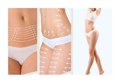 內視鏡矽膠假體隆乳 26 威塑體雕相關療程